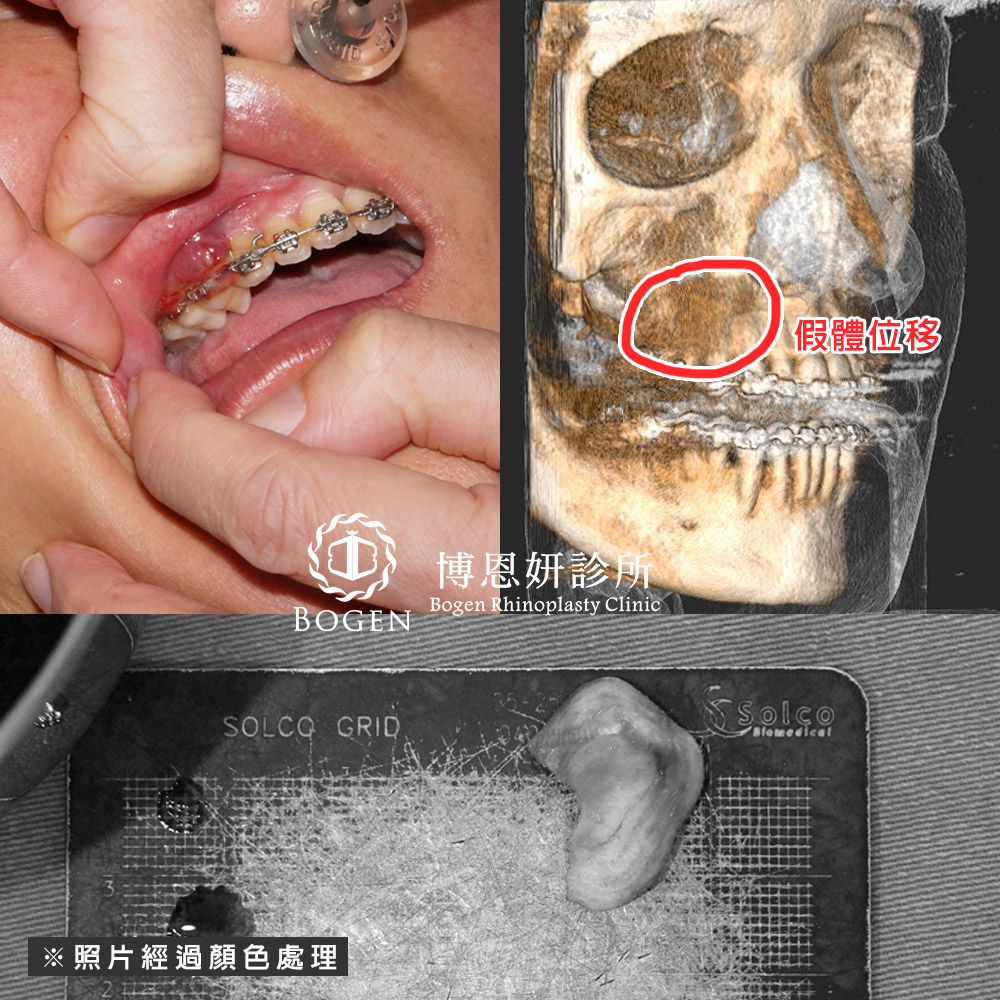 法令紋手術後出現口腔內肉瘤,法令紋植體脫落,法令紋手術,博恩妍